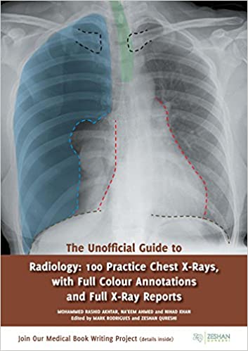راهنمای غیر رسمی رادیولوژی: 100 اشعه ایکس قفسه سینه با حاشیه نویسی کامل و گزارش کامل اشعه ایکس - رادیولوژی
