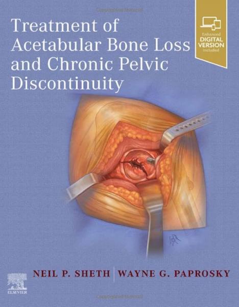 Treatment of Acetabular Bone Loss and Chronic Pelvic Discontinuity (2024)1st Edition - جراحی
