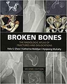 استخوان های شکسته: اطلس رادیولوژیک شکستگی ها - اورتوپدی
