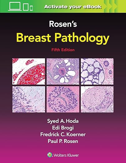 تشخیص Rosens از آسیب شناسی پستان - پاتولوژی